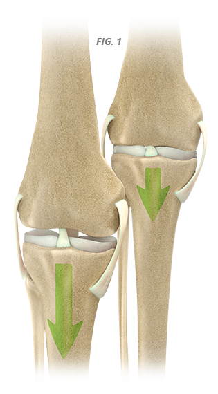 Non-surgical Knee Decompression Therapy Charlotte